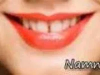 دندان های فاصله دار