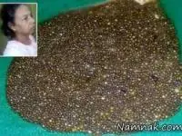 سنگ کیسه صفرا