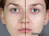 مشکلات پوستی