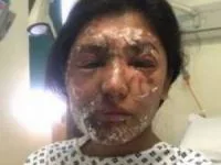صورت اسید پاشی
