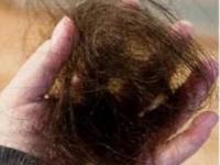 ریزش موی ناگهانی