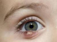 درمان گل مژه