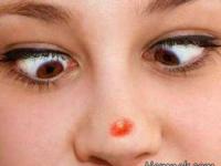 آرایش جوش صورت