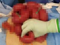 بادکنک در شکم پسر جوان