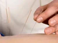 طب سوزنی در بارداری