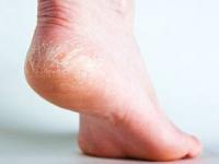 درمان ترک پا