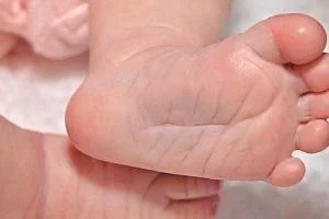 کج شدن پای نوزاد
