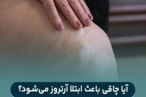 ابتلا به آرتروز به دلیل چاقی و اضافه وزن