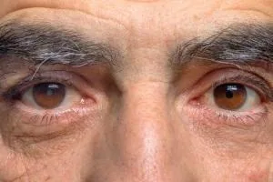 آب مروارید