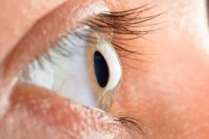 قوز قرنیه