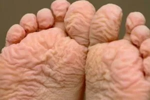 علت چروک انگشتان