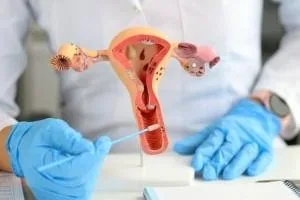 سندرم پلی کیستیک