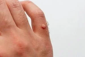 رژیم غذایی برای درمان زگیل
