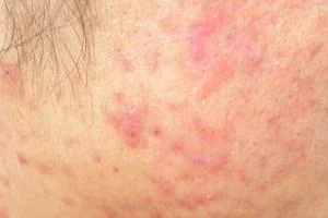 جوش و آکنه