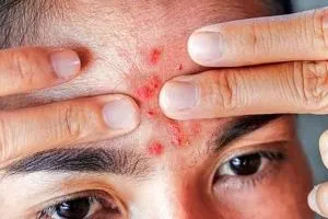 جوش زدن صورت