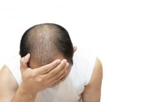 ریزش مو