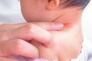 حساسیت غذایی