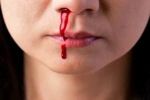 بیماری هموفیلی