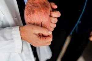 بیماری آلزایمر