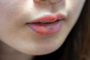 تبخال لب در بارداری