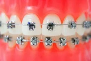 ارتودنسی دندان