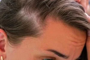 ریزش موی تیروئیدی