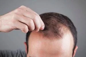 بی خوابی ریزش مو