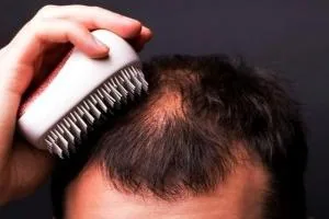 آلوپسی اره اتا