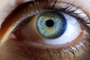 آلزایمر