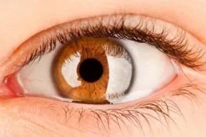 علائم رتینوپاتی دیابتی