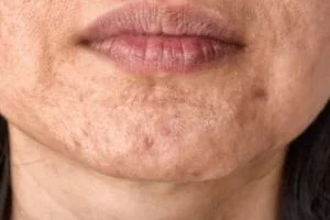جوش در تابستان