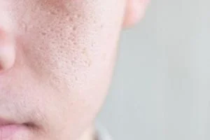 منافذ باز پوست