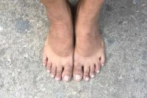 بعد آفتاب سوختگی