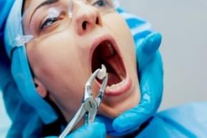 کشیدن دندان عقل