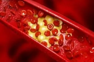 تمیز کردن دیواره شریان ها‬‎