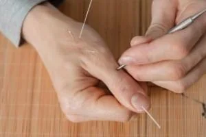 طب سوزنی برای درمان چاقی