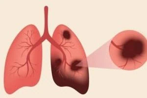 پاکسازی ریه افراد سیگاری