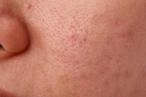 منافذ باز پوست