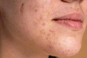 جوش صورت