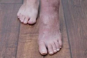 پاهای ورم کرده