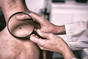 علائم خال سرطان