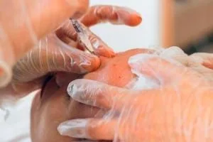 مزوبوتاکس چیست