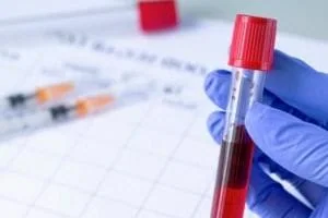 آزمایش ایدز
