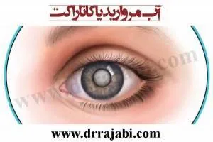 آب مروارید
