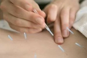 طب سوزنی