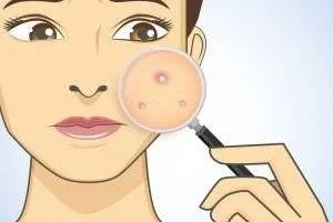 درمان جای جوش