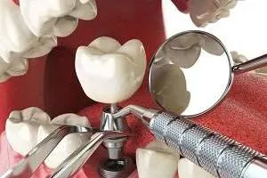 ایمپلنت دندان