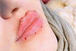 تزریق ژل لب