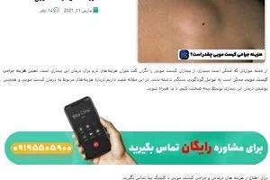 هزینه عمل کیست مویی