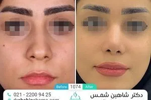 جراحی بینی